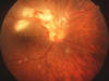 This retinal photograph demonstrates an opacified, edematous retina (yellow) and hemorrhage (red); the retinitis involves the optic nerve head and extends adjacent to the macula along the retinal blood vessels.