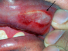 The black arrow points to a large aphthous lesion on the lip.