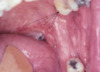 The black arrows denote the multiple (herpetiform) aphthous lesions on the buccal mucosa.&nbsp;