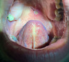 Ulcer on hard palate (black arrow).