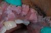 Several larger papillary warts leions on the upper oral labial mucosa