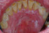 Diffuse Leukoplakia and ulceration in gingiva and floor of the mouth