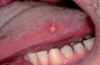 The yellow arrow denotes a small (minor) aphthous lesion on the lateral area of the tongue.&nbsp;