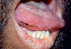 The black arrow points to large aphthous lesion on lateral tongue.