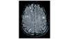 The MRI scan shows multiple lesions.