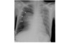 This chest radiograph scan shows a right lung pneumothorax (white arrows) in an adult with HIV and <em>Pneumocystis</em> pneumonia.