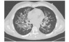 This chest CT scan shows extensive bilateral infiltrates in an adult with HIV and <em>Pneumocystis</em> pneumonia.