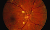 This retinal photograph taken of a person with HIV retinopathy shows multiple cotton wool spots. These cotton wool spots represent nerve fiber layer infarcts, identical to those often seen in persons with hypertension or diabetes mellitus. These lesions do not cause symptoms and resolve spontaneously.