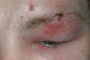 Abbreviations: MRSA = methicillin-resistant <em>Staphylococcus aureus</em>