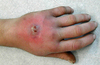 Abbreviations: MRSA = methicillin-resistant <em>Staphylococcus aureus</em>