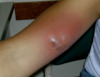 Abbreviations: MRSA = methicillin-resistant <em>Staphylococcus aureus</em>