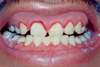 Oral examination that shows intense erythema along the upper and lower gum lines