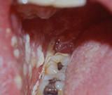 White plaques on buccal mucosa consistent with pseudomembranous candidiasis