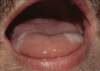 The white plaques on the lateral aspect of the tongue were not removed by scraping with a tongue-blade.