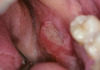 Large and deep ulcerated lesion on left alveolar mucosal region with fibrinous material at lower portion of ulcer. The alveolar process refers to the ridge of bone that contains the tooth sockets.&nbsp;