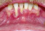 Oral examination showing significant tissue loss along the lower gum lin