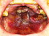 Diffuse infiltrative exophytic mass on upper palate