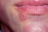 Characteristic focal cluster of vesicular lesions with a surrounding erythematous base.