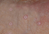 Note the characteristic central umbilication of the lesions.