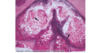This hematoxylin and eosin-stained skin biopsy taken from a patient with AIDS and molluscum shows lobules of keratinocytes that contain numerous large eosinophilic intracytoplasmic inclusion bodies (Henderson-Patterson, or molluscum bodies) [arrows]. Magnification x20.
