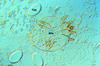 Microscopy slide of skin scraping from patient with crusted scabies showing a scabies mite and multiple scabies eggs.