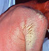 This image of a patient with AIDS and a CD4 count less than 100 cells/mm<sup>3</sup> shows a diffuse erythematous rash, with plaque-like lesions in the shoulder region.
