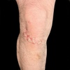 This photograph shows characteristic scaling and plaque-like lesions on the extensor surface of the knees.&nbsp;