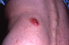Abbreviations: MRSA = methicillin-resistant <em>Staphylococcus aureus</em>