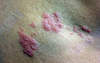 Note the cluster of vesicular lesions that have a surrounding erythematous base.