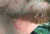 Erythematous rash on face in beard region