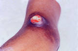 Nodular lesion in right antecubital fossa with exposed surface