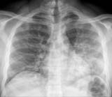 Chest radiograph showing diffuse pulmonary infiltrates in an adult with HIV and mild <em>Pneumocystis</em> pneumonia.