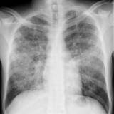 Chest radiograph of adult with severe <em>Pneumocystis</em> pneumonia.
