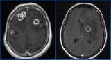 The image on the left shows multiple ring-enhancing lesions. The image on the right shows a large ring-enhancing lesion with surrounding edema and mass effect.