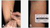 A. The standard Mantoux tuberculin skin test is performed by injecting 0.1 mL of 5 tuberculin purified protein derivative (PPD) units intradermally on the volar surface of the forearm.<br />
B.&nbsp;The transverse diameter of cutaneous induration (not erythema) should be measured 48 to 72 hours after placement of the PPD.