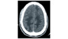 This contrast CT scan shows multiple ring-enhancing lesions with surrounding vasogenic edema.