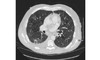This chest CT scan shows patchy bilateral infiltrates and extensive cavitary lesions in an adult with HIV and disseminated histoplasmosis.