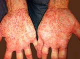 Erythematous, maculopapular rash on palms