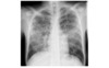 This chest radiograph scan shows extensive bilateral infiltrates in an adult with HIV and <em>Pneumocystis</em> pneumonia.