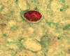 Modified acid-fast smear of stool sample showing <em>Cystoisospora belli</em> oocyst with internal granular mass (zygote).