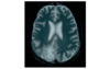 This T2-weighted MRI scan shows diffuse confluent lesions most prominent in the occipital lobes.