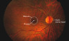 This image of a normal retina identifies important landmarks visible with a hand-held ophthalmoscope. The macula is in the center of the retina; it contains densely packed cones that specialize in visual acuity and color vision. The fovea is the central depression within the macula. The visible portion of the optic nerve is the optic nerve head or optic disc. Retinal veins and arteries are prominently seen extending from the optic nerve.