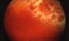 This retinal photograph taken of a person with HIV and cytomegalovirus retinitis shows extensive retinitis in a brushfire pattern in the upper and right region of the image. In the area farthest to the upper right, retinal necrosis and atrophy have led to retinal pigment epithelial change, as evident by the darkly pigmented appearance.