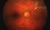 This retinal photograph is taken from a person with HIV in whom cytomegalovirus retinitis (arrow) developed in a slower fashion ("smoldering CMV retinitis"). This "smoldering" type of lesion often does not cause noticeable symptoms and may escape detection until it extends closer to the site-threatening region (zone 1).