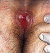 This man with advanced HIV developed a slowly expanding ulcerating lesion in the upper region of the gluteal cleft.