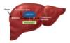 Atazanavir can increase serum total bilirubin through inhibition of the liver enzyme uridine diphosphate glucuronosyltransferase 1A1 (UGT1A1); this enzyme is a key enzyme in the normal glucuronidation of bilirubin.<br />
Abbreviation: UGT1A1 = uridine diphosphate glucuronosyltransferase 1A1